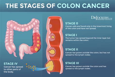 colon cancer symptoms stage 3